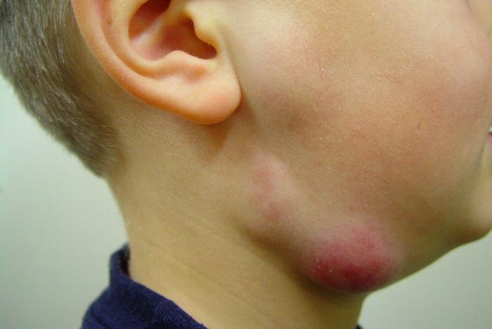 Воспалился лимфоузел под челюстью: причины увеличения подчелюстных лимфоузлов, что делать и как лечить
