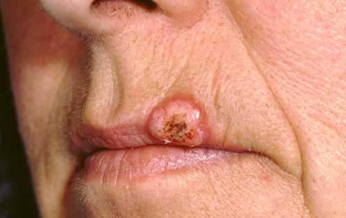 Кератоакантома губы