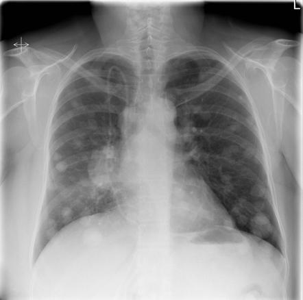 Метастазы хориокарциномы в лёгких