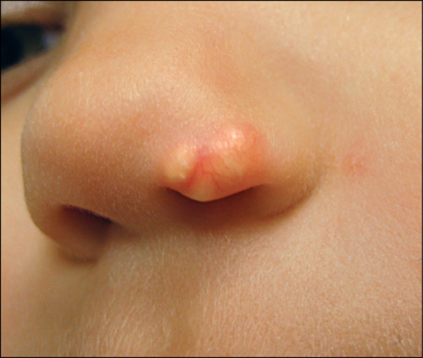 Эпителиома на носу