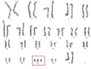 Анеуплоидия 21 пары хромосом