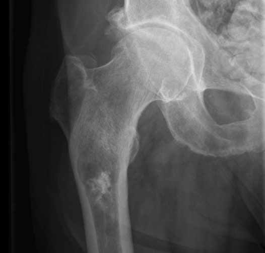 Опухоль в трубчатой кости на рентгене