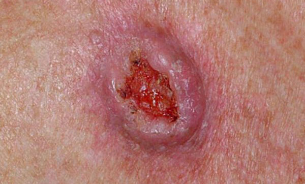 Базалиома кожи лица симптомы thumbnail