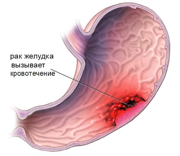 Злокачественная опухоль желудка