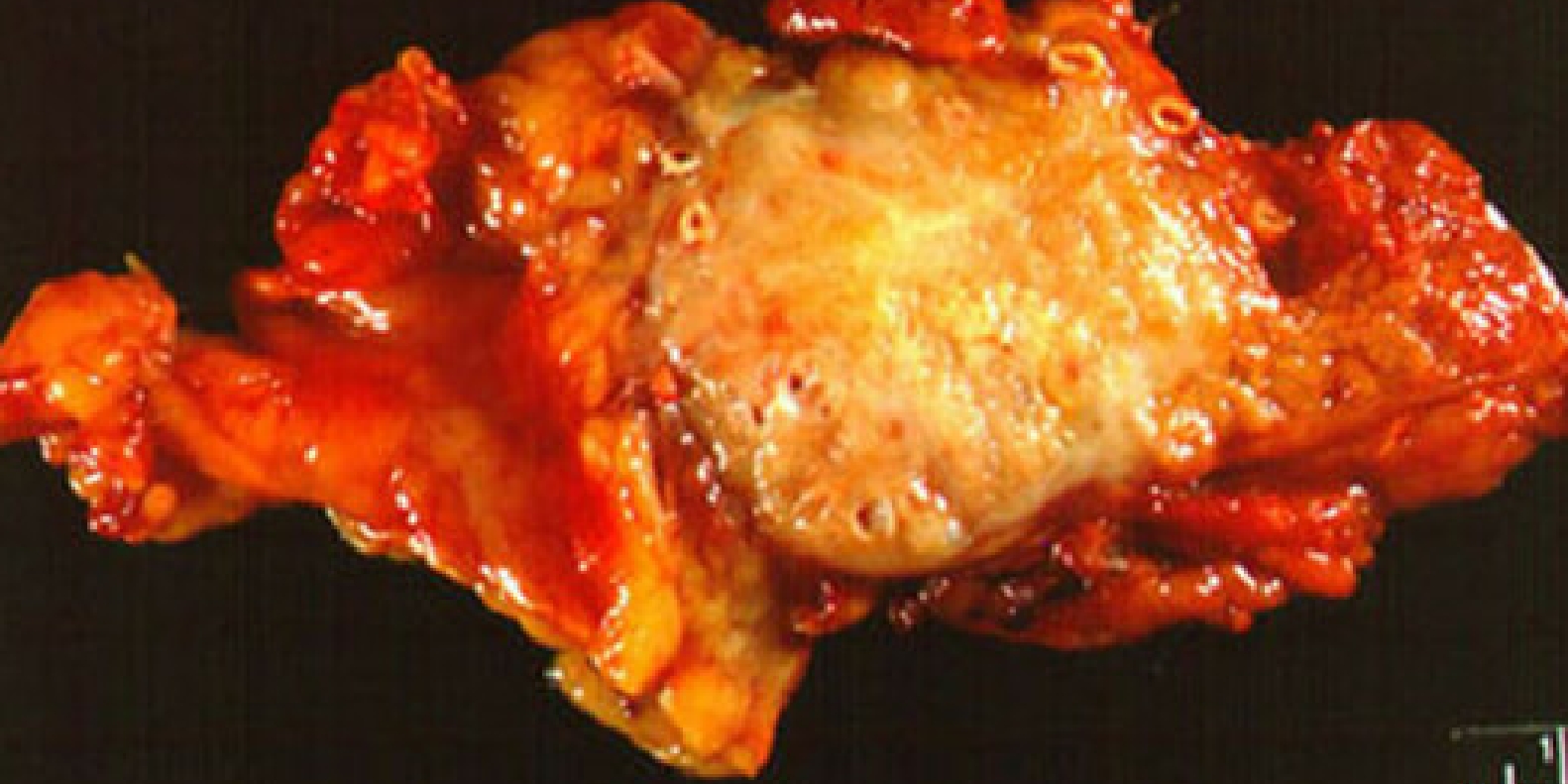 Что такое аденогенный рак поджелудочной железы thumbnail