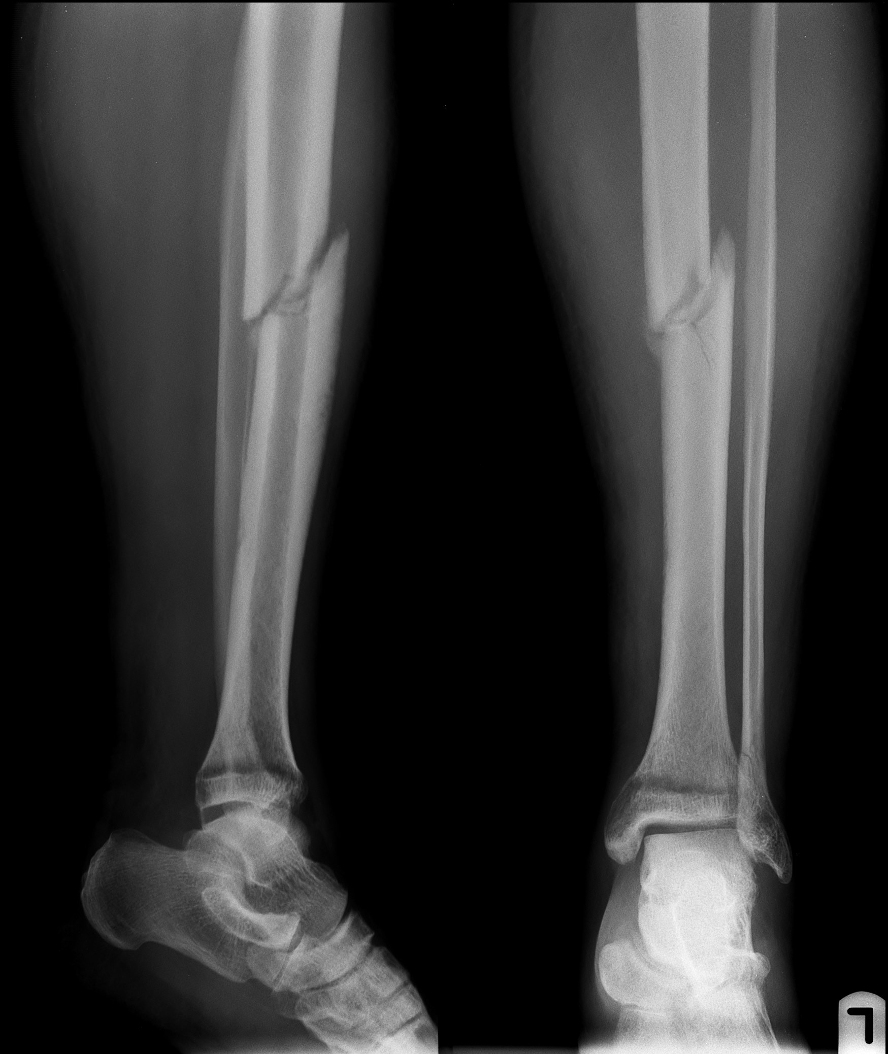 Снимок трещины. Перелом берцовой кости рентген. Поперечный перелом берцовой кости. Перелом кости голени рентген. Перелом голени рентген.