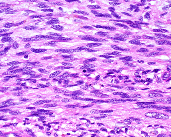 Клетки веретеноклеточной саркомы