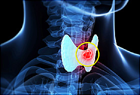Папиллярная аденома щитовидной железы