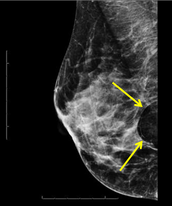 Миолипома. Фибролипома молочной железы рентген. Липома молочной железы маммограмма. Липома молочной железы маммография УЗИ. Фибролипома маммография.