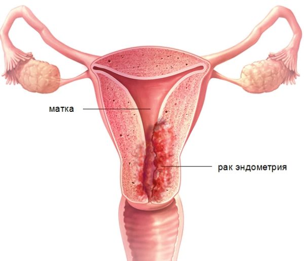 Виды саркомы эндометрия матки