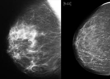 Маммография молочной железы