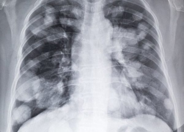 Метастазы в лёгких