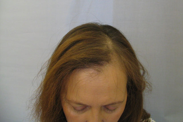 После лучевой волосы выпадают. Причёски при алопеции у женщин.