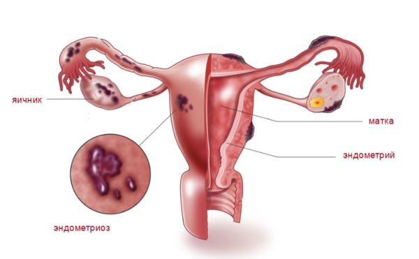 Эндометриоз в матке