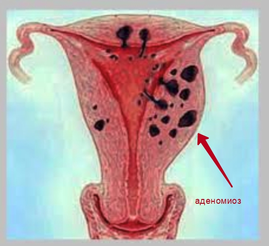 Аденомиоз у женщины