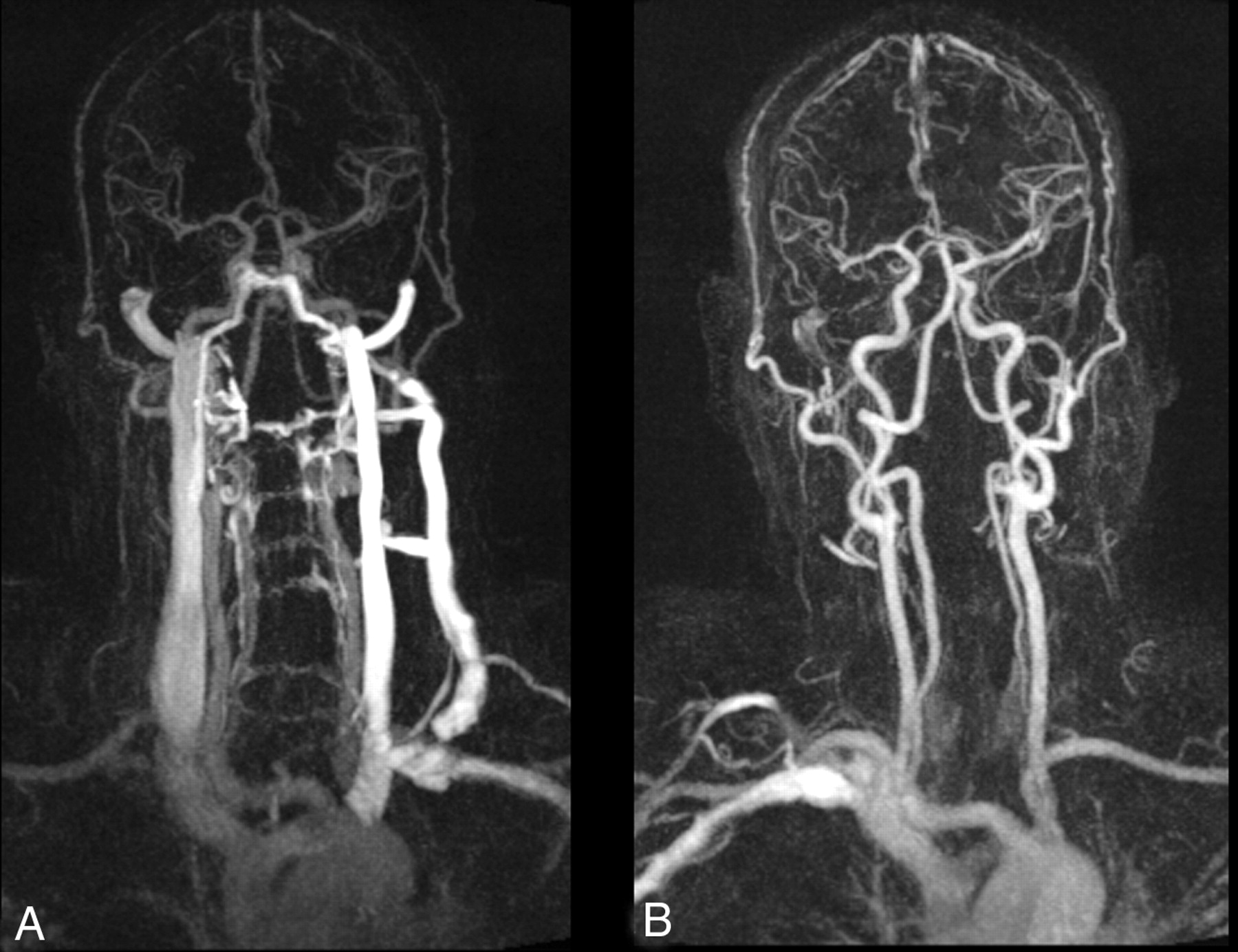 Мрт головы и шеи. Магнитно-резонансная ангиография артерий головного мозга. МРА (магнитно-резонансная ангиография). МР-ангиография артерий шеи. Компьютерно-томографическая ангиография сосудов головного мозга.