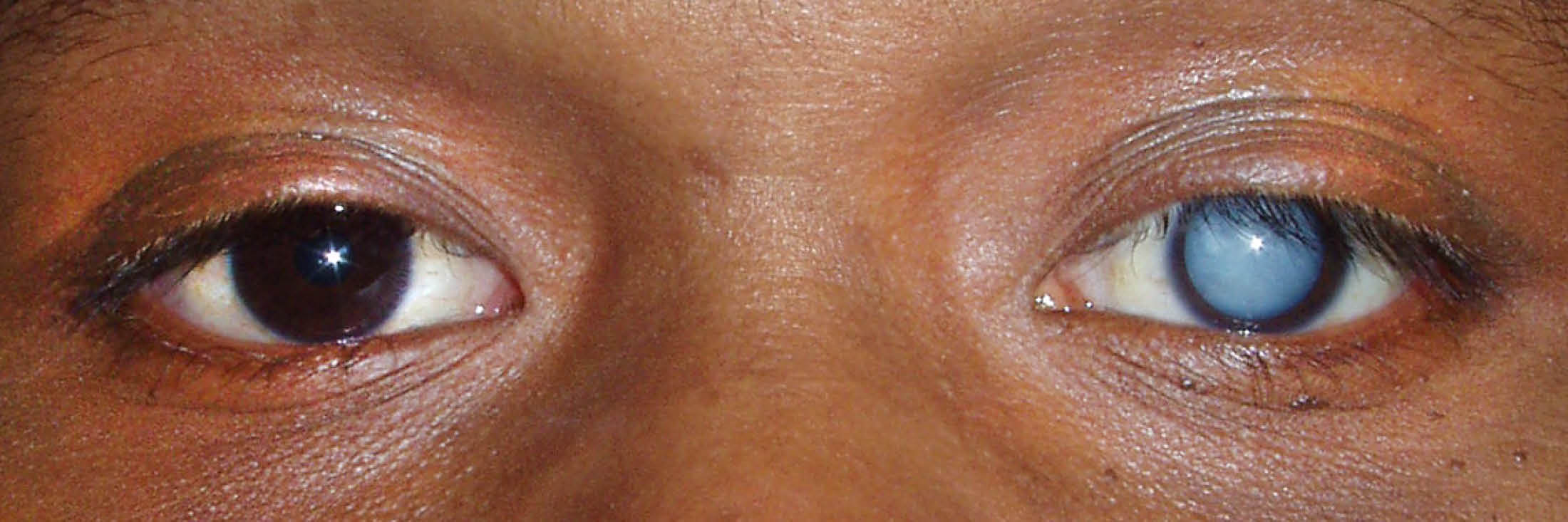 Один глаз открыт другой закрыт. Тетаническая катаракта. Старческая(сенильная)катаракта. Дерматогенная катаракта.
