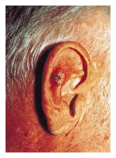 Спиноцеллюлярная эпителиома уха