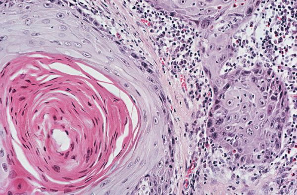 Гистологическая картина плоскоклеточного рака лёгких