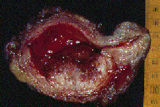 Уротелиальная карцинома мочевого пузыря