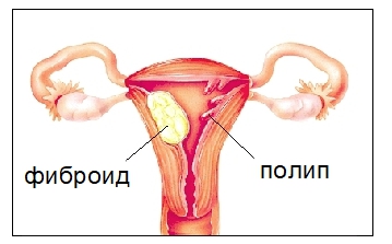 Полип в матке: лечение без операции, как лечить полип эндометрия без хирургического вмешательства, отзывы пациентов о лечении в Москве
