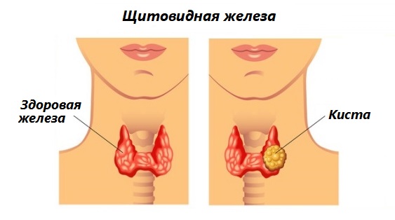 Кистозная полость в щитовидной железе