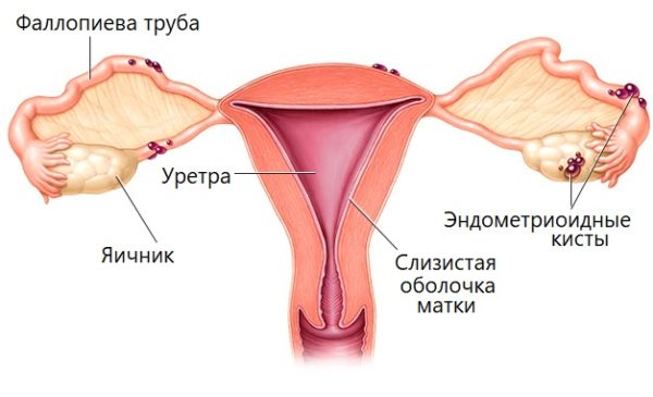 Эндометриоидные кисты на яичнике