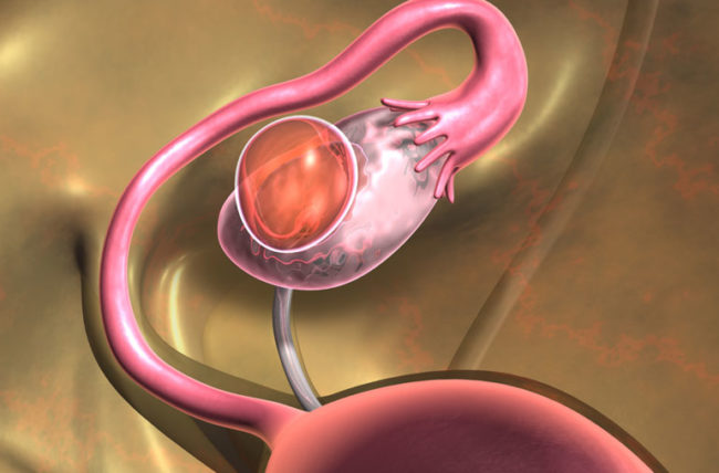 Серозная киста яичника: симптомы, лечение, причины и диагностика