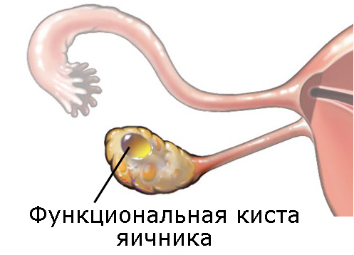 Функциональная киста яичника