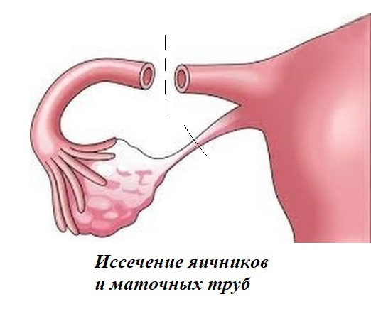 Проведение овариотубоэктомии