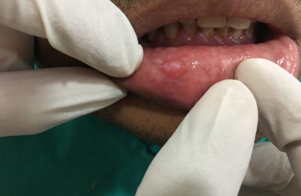 Осмотр губы у стоматолога