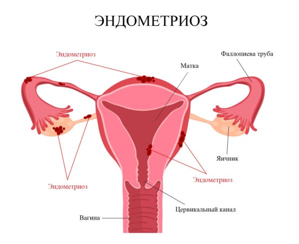 Эндометриоз у женщины