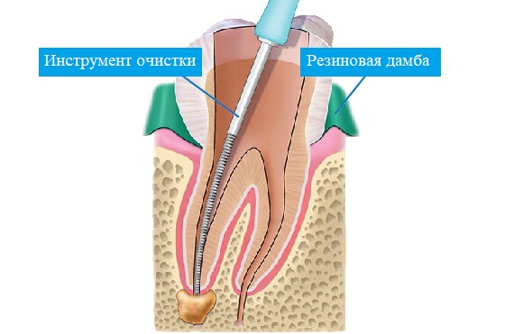 Чистка зубного канала