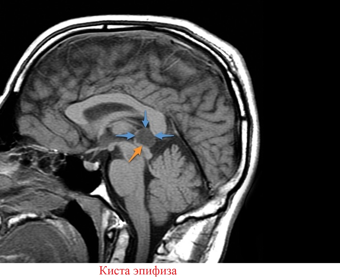 Киста в голове. Мрт головного мозга эпифиз. Киста шишковидной железы головного мозга мрт.