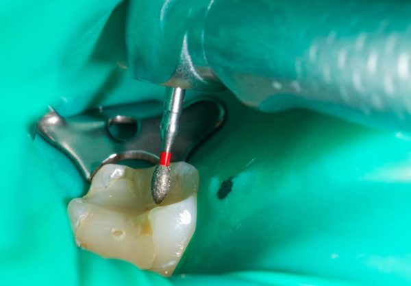 Удаление нерва проблемного зуба