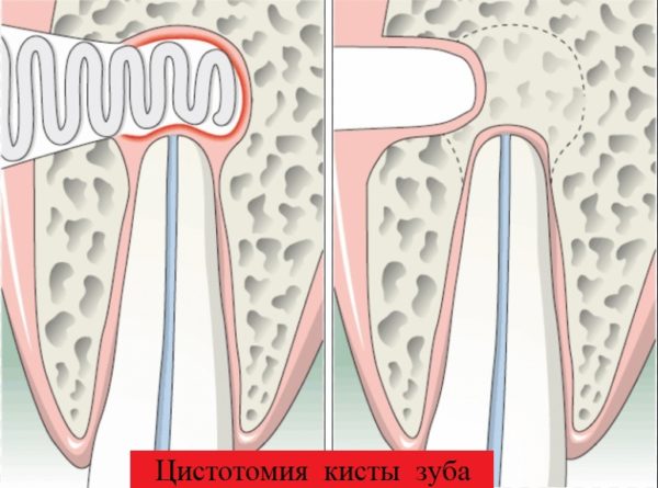 Цистотомия кисты зуба