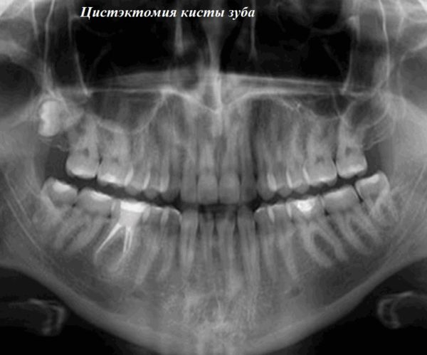 Цистэктомия кисты зуба