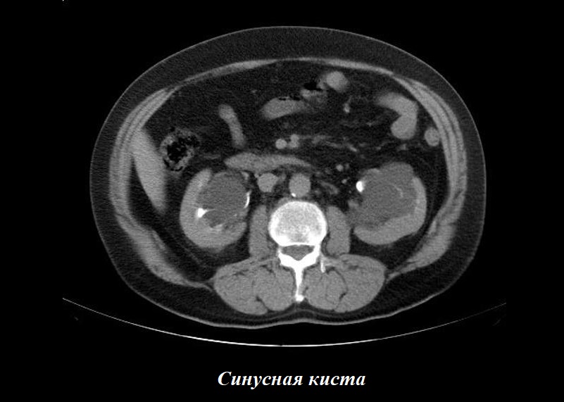 Синусовая киста почки